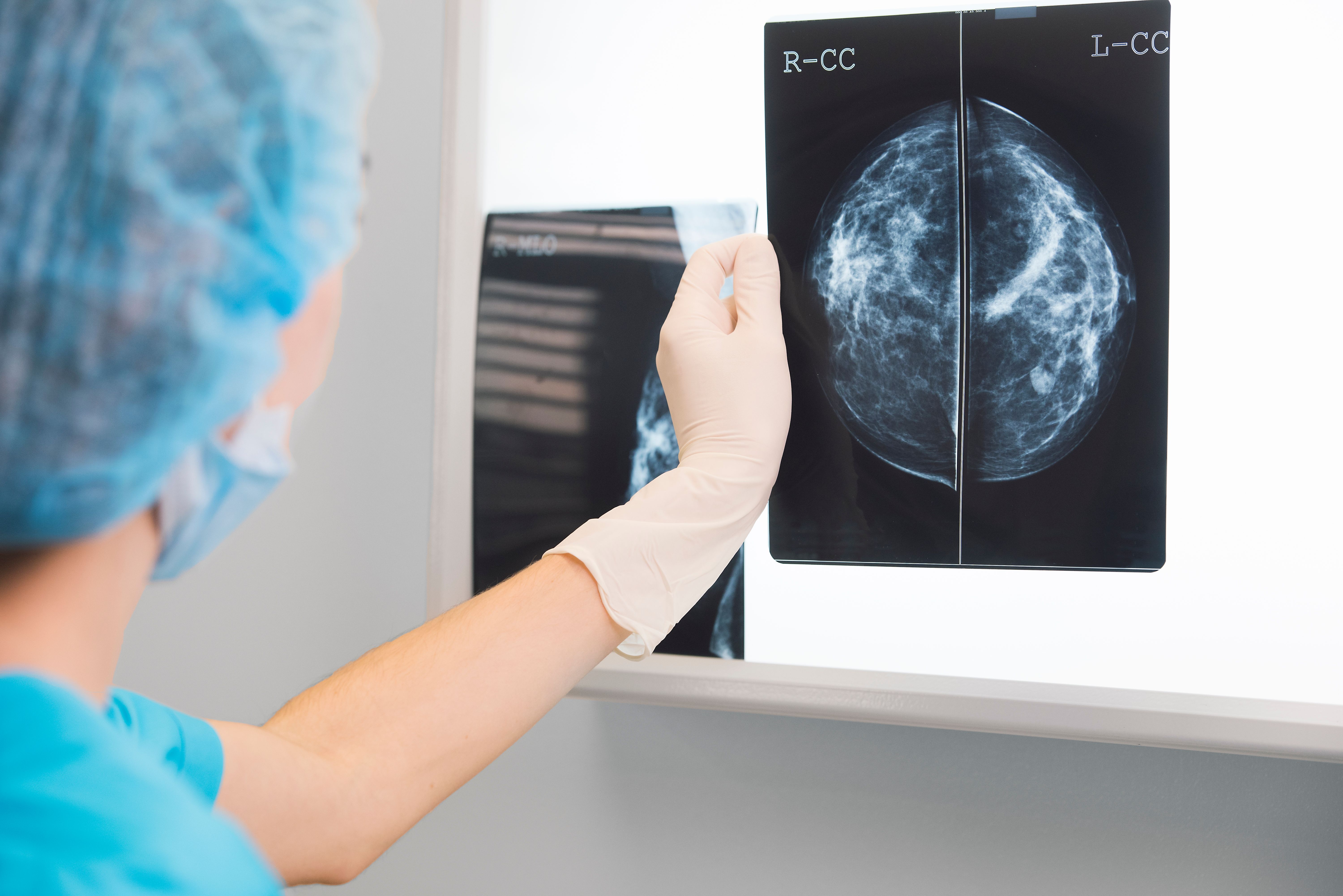 Arzt schaut sich Mammographie-Bild.